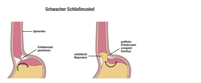 Grafik eines zu schwachen Schließmuskels der die Refluxkrankheit verursacht und somit zu Sodbrennen führt.