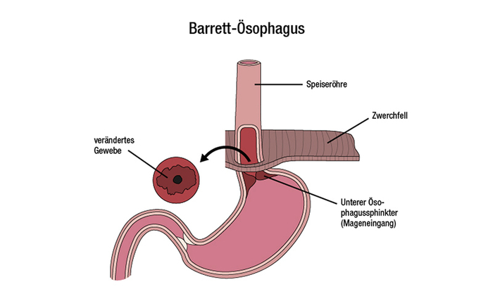 Grafische Darstellung eines Barrett-Ösophagus infolge einer Refluxkrankheit