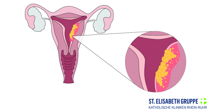 Das Endometriumkarzinom entwickelt sich an der Gebärmutterwand und ist eine bösartige Veränderung der Gebärmutterschleimhaut