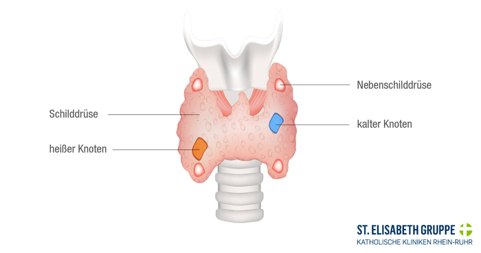 Medizinische Grafik zu heißen und kalten Schilddrüsenknoten.