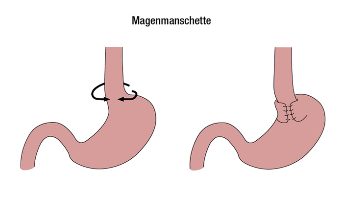 Grafische Darstellung einer Magenmanschette zur operativen Behandlung der Refluxkrankheit
