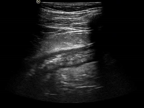 Die Sonografie zeigt eine Divertikulitis mit Imbibierung des umliegenden Fettgewebes. Das heißt, dass das Gewebe durchtränkt von Flüssigkeiten ist.