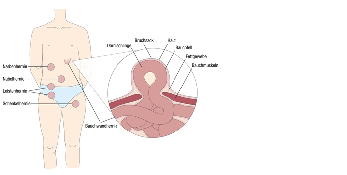 Hernienarten im Körper Infografik