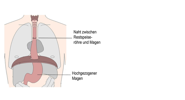 Operation Speiserörenkrebs Minimal Invasiv Schaubild