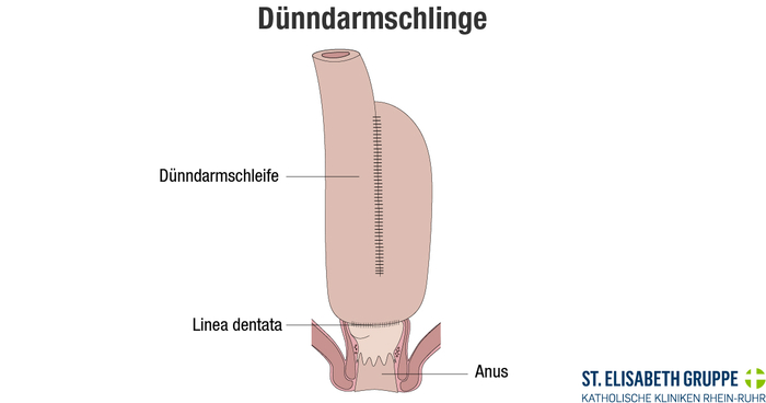 Grafische Darstellung einer ileonalen Pouchanlage zur Behandlung von Colitis ulcerosa