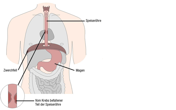 Grafische Darstellung eines Oberkörpers mit seinen Organen. In der Speiseröhre tritt eine bösartige Wucherung auf: Speiseröhrenkrebs.
