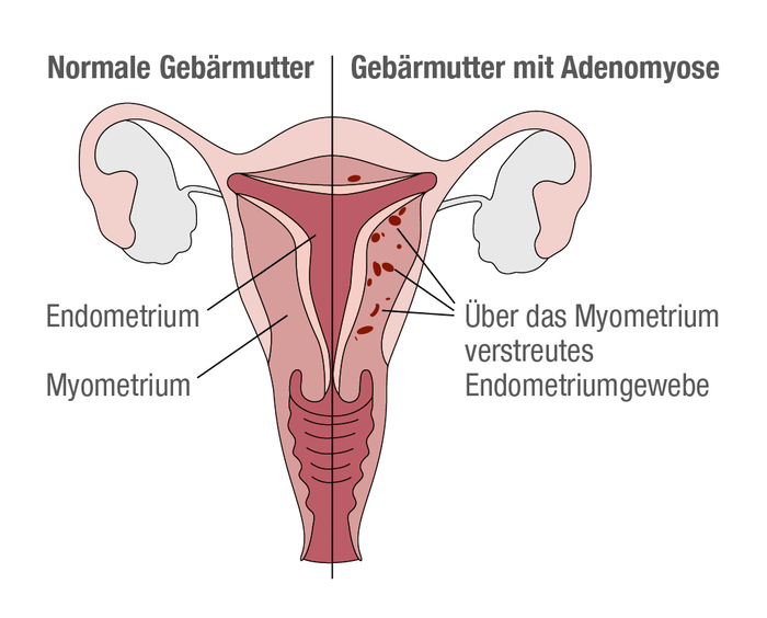Grafik, die Unterschiede zwischen einer gesunden gebärmutter und einer Gebärmutter mit Adenomyose zeigt