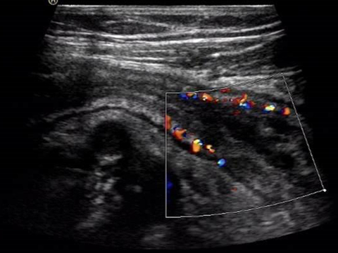 Sonografie einer entzündlich verdickten Darmwand bei Morbus Crohn