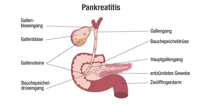 Grafische Darstellung einer akuten Pankreatitis, die durch Gallensteine verursacht wurde