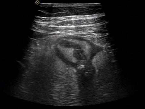 Ultraschallbild einer verdickten Darmwand im Farbdoppelmodus