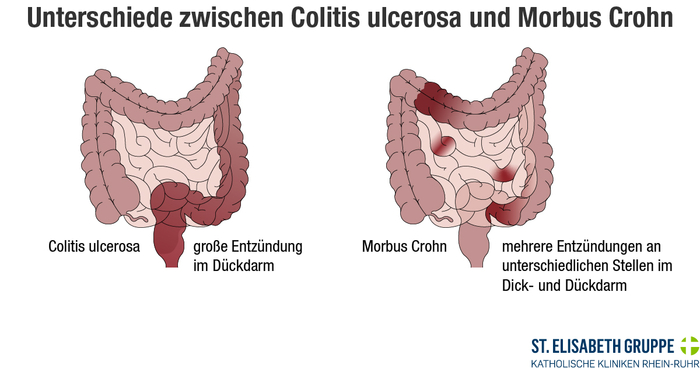 Grafische Darstellung der Unterschiede zwischen Morbus Crohn und Colitis ulcerosa